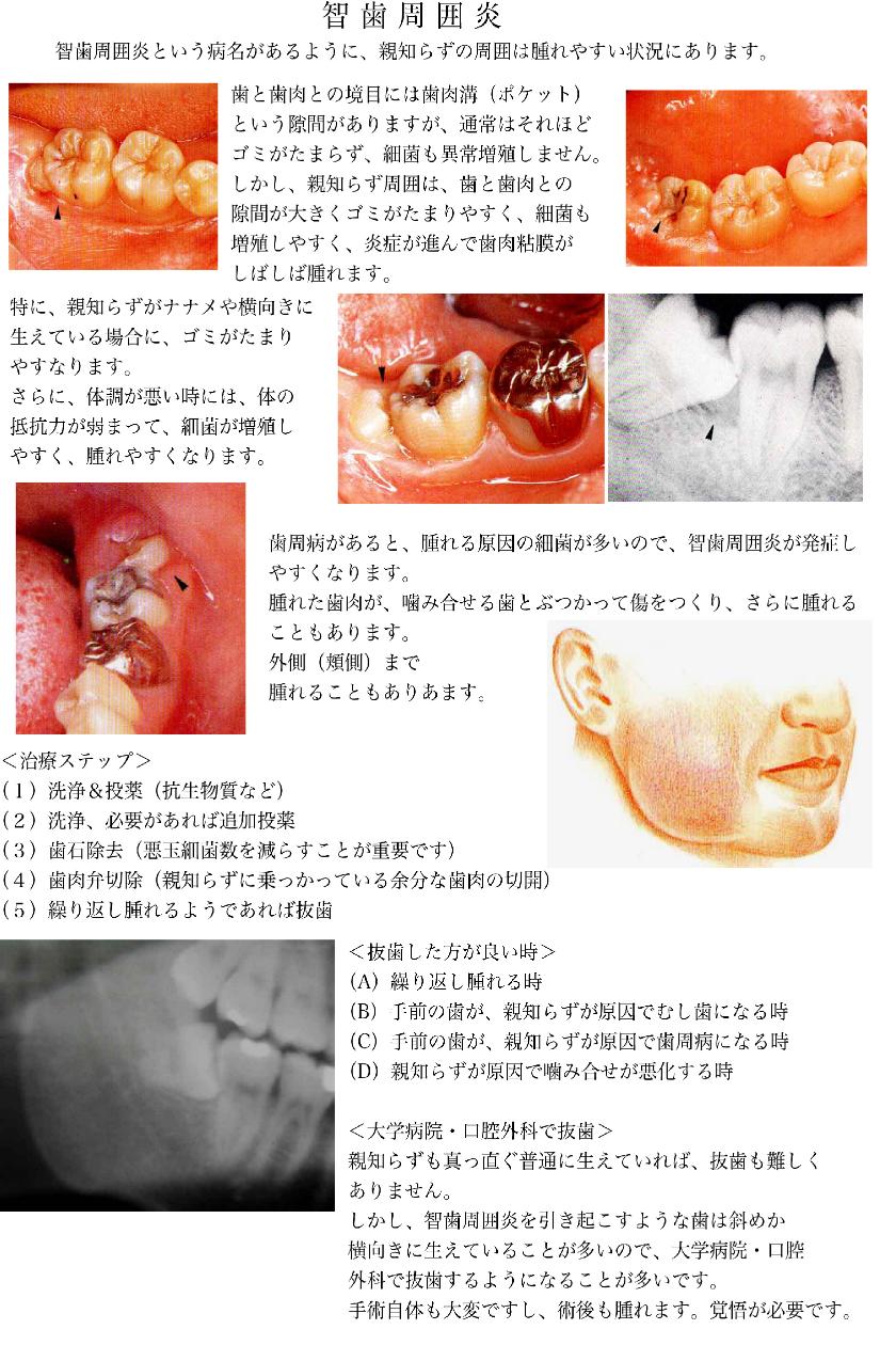 智歯周囲炎パンフ01 のコピー 17